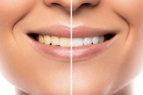 whiten stained teeth