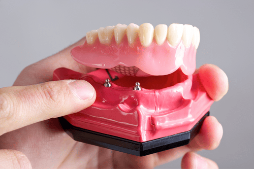 permanent implant dentures