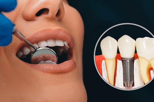 dental implants